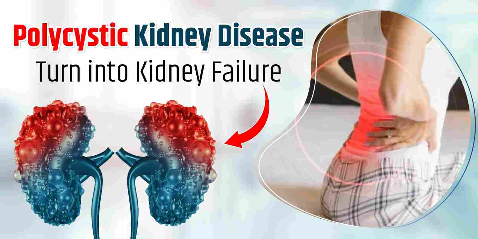 Polycystic Kidney Disease Turn into Kidney Failure
